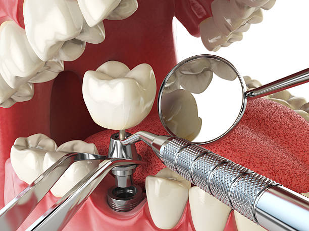 Best Broken or Chipped Tooth Repair in Shingletown, CA